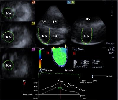 Tricuspid annular and right atrial volume changes are associated in healthy adults—insights from the three-dimensional speckle-tracking echocardiographic MAGYAR-Healthy Study